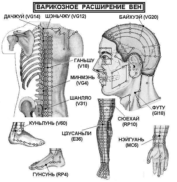 Варикоз Вен Лечение Пиявками