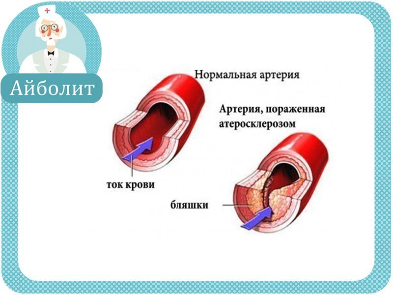 Укрепление сосудов. Для укрепления сосудов. Ослабление стенок сосудов. Истощение стенок сосудов. Для циркуляции крови и укрепления сосудов.